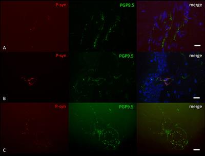 Dermal Phospho-Alpha-Synuclein Deposition in Patients With Parkinson's Disease and Mutation of the Glucocerebrosidase Gene